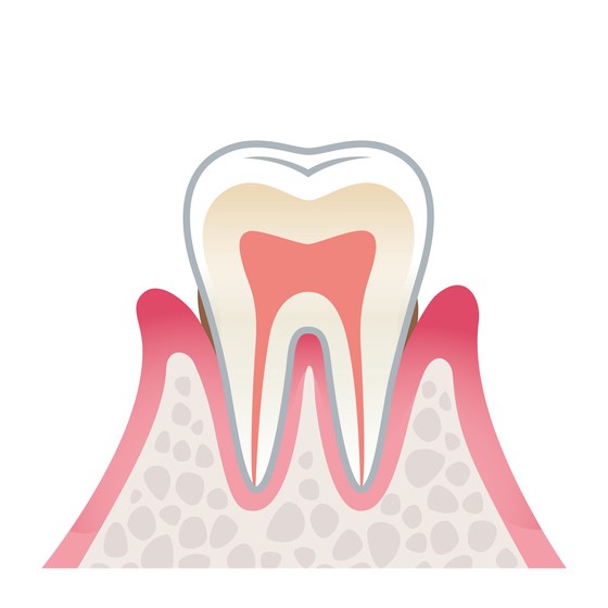 歯肉炎(初期～中程度)